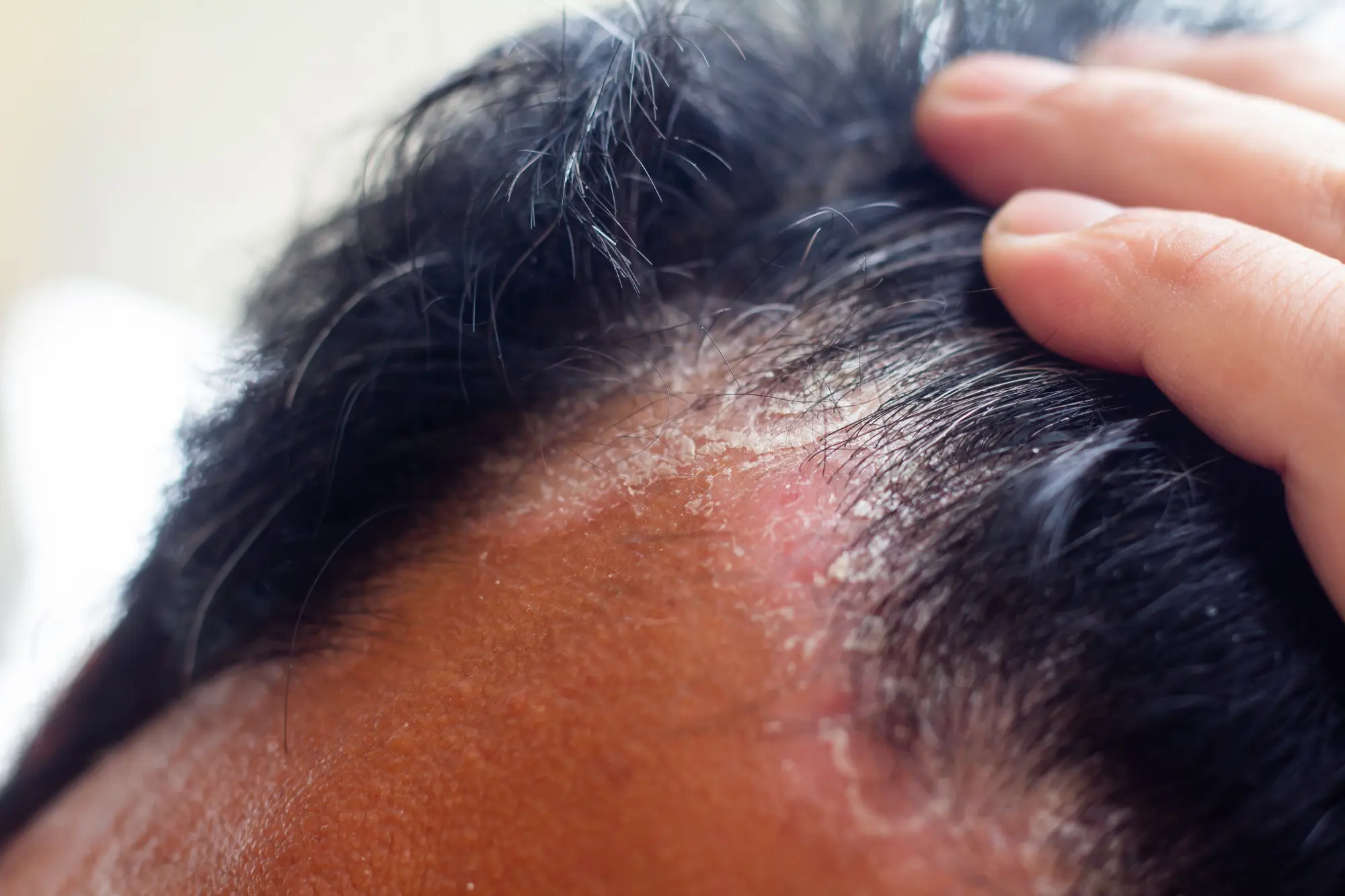 A Biltmore Dermatology client ready for Hair and Scalp treatment